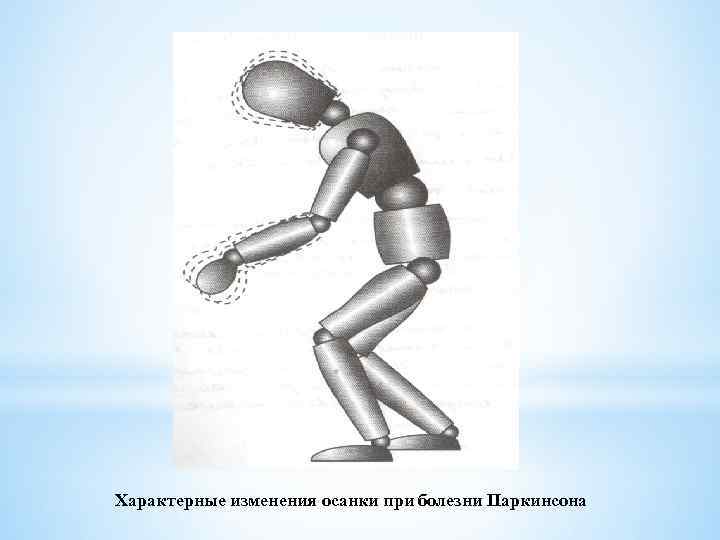Характерные изменения осанки при болезни Паркинсона 
