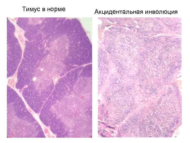 Тимус в норме Акцидентальная инволюция 