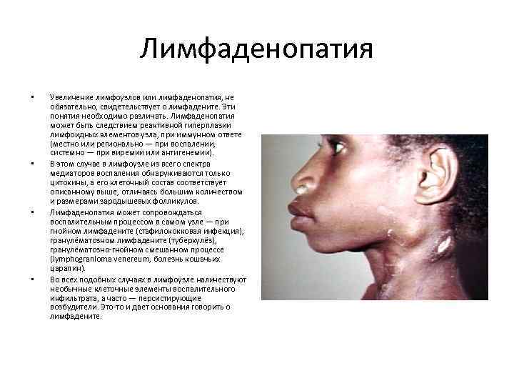 Лимфаденопатия • • Увеличение лимфоузлов или лимфаденопатия, не обязательно, свидетельствует о лимфадените. Эти понятия