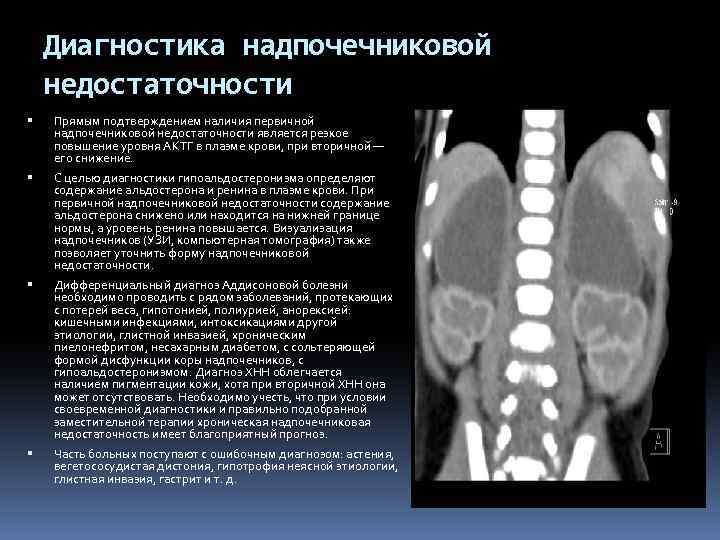 Дефицит надпочечников. Болезнь Аддисона кт надпочечников. Вторичная надпочечниковая недостаточность мкб 10. Первичная надпочечниковая недостаточность (болезнь Аддисона). Диагностика первичной надпочечниковой недостаточности.