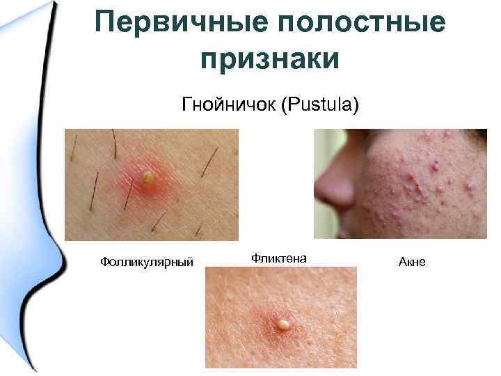 Первичные полостные признаки Гнойничок (Pustula) Фолликулярный Фликтена Акне 