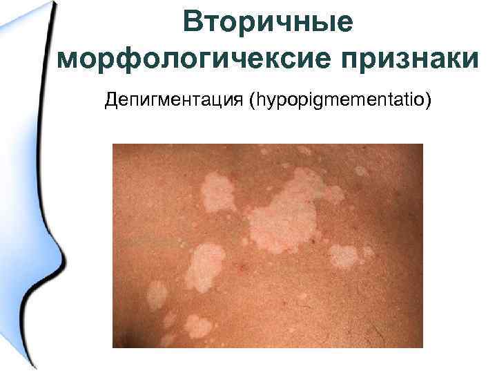 Вторичные морфологичексие признаки Депигментация (hypopigmementatio) 