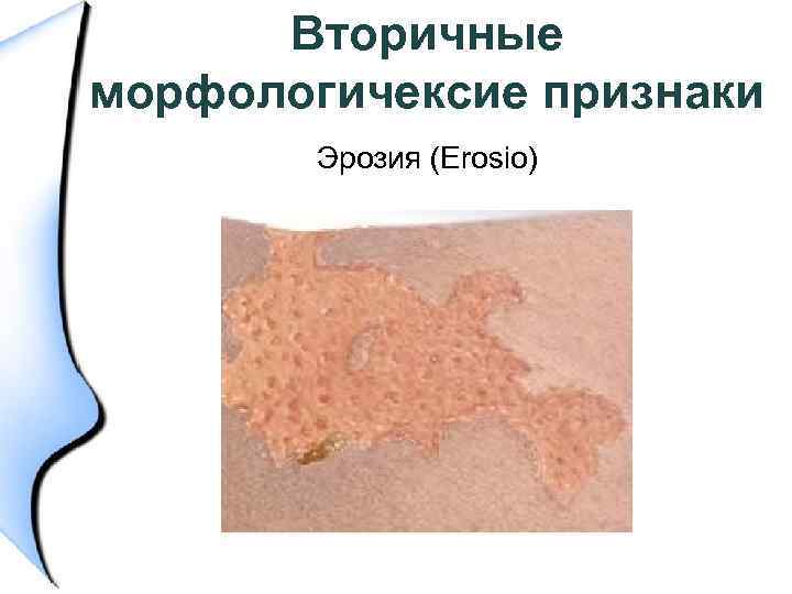 Вторичные морфологичексие признаки Эрозия (Erosio) 