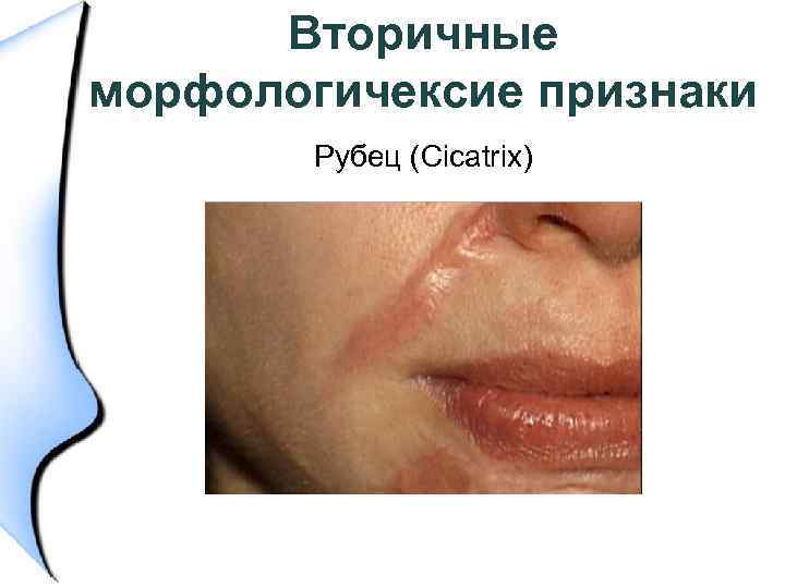 Вторичные морфологичексие признаки Рубец (Cicatrix) 