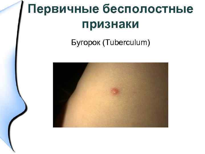 Первичные бесполостные признаки Бугорок (Tuberculum) 