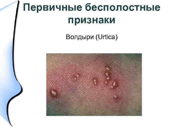 Первичные бесполостные признаки Волдыри (Urtica) 