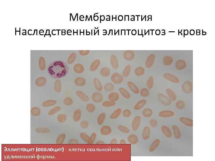 Мембранопатия Наследственный элиптоцитоз – кровь Эллиптоцит (овалоцит) клетка овальной или удлиненной формы. 