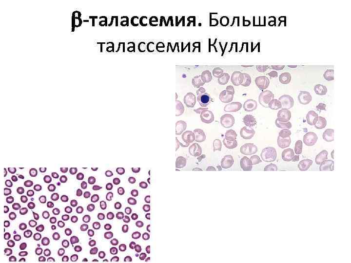  талассемия. Большая талассемия Кулли 