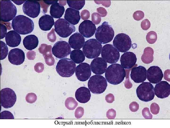 Острый лимфобластный лейкоз 