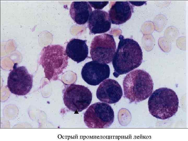 Острый промиелоцитарный лейкоз 