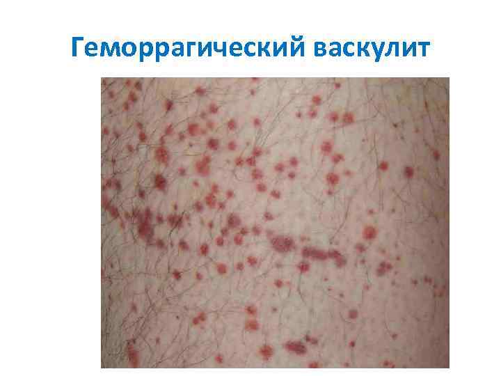 Геморрагический васкулит 