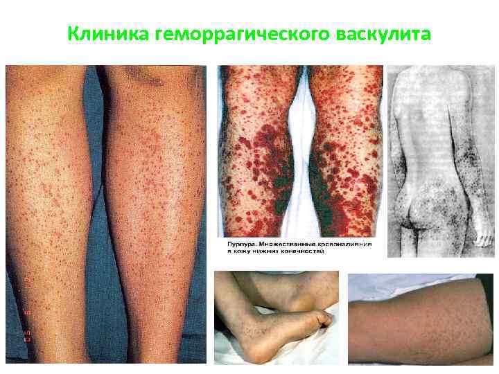Клиника геморрагического васкулита 