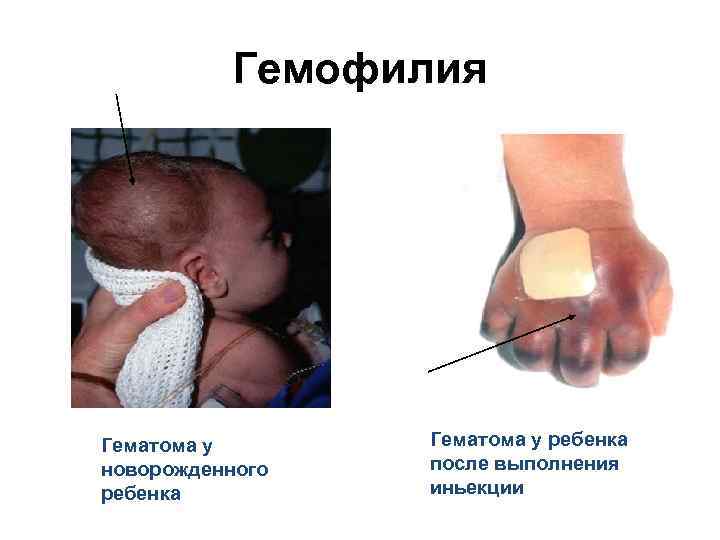 Гемофилия Гематома у новорожденного ребенка Гематома у ребенка после выполнения иньекции 