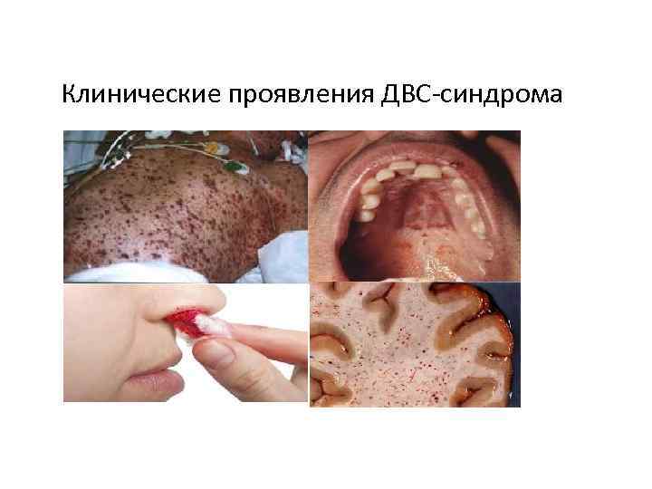 Клинические проявления ДВС-синдрома 