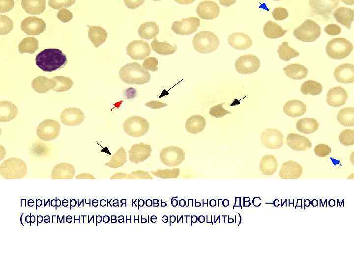 периферическая кровь больного ДВС –синдромом (фрагментированные эритроциты) 