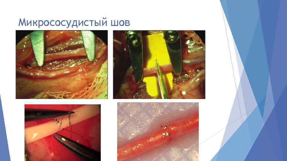 Микрососудистый шов 