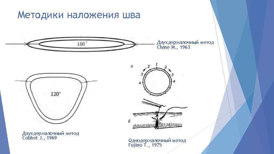 Методики наложения шва Двухдержалочный метод Chase М. , 1963 Двухдержалочный метод Cobbet J. ,