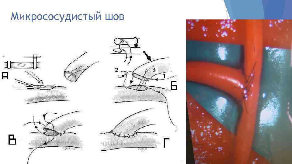 Микрососудистый шов 