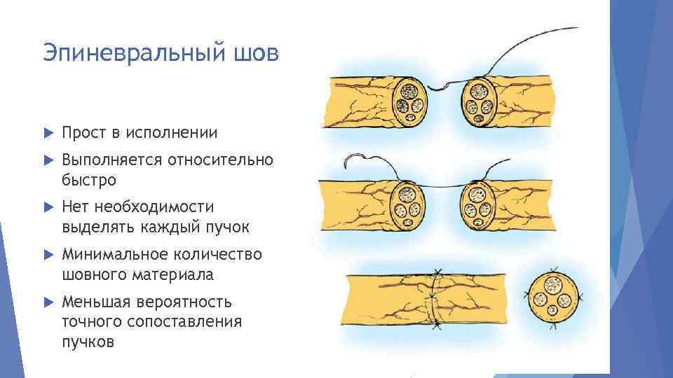 Эпиневральный шов Прост в исполнении Выполняется относительно быстро Нет необходимости выделять каждый пучок Минимальное