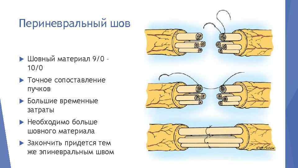 Периневральный шов Шовный материал 9/0 – 10/0 Точное сопоставление пучков Большие временные затраты Необходимо