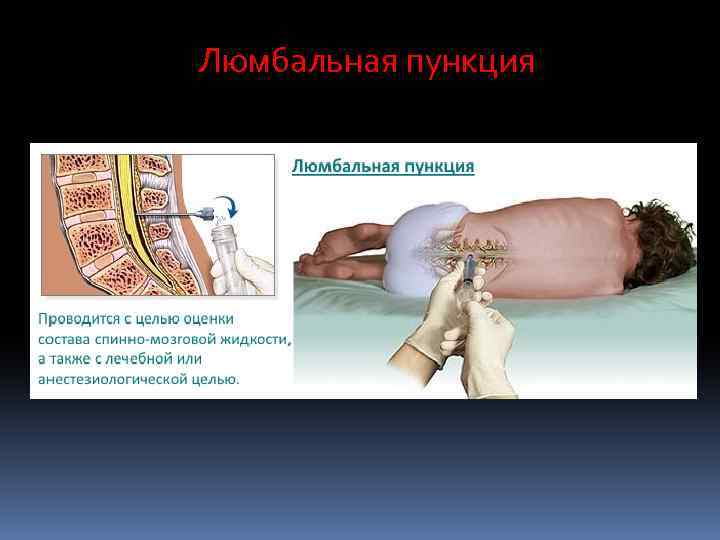 Люмбальная пункция 