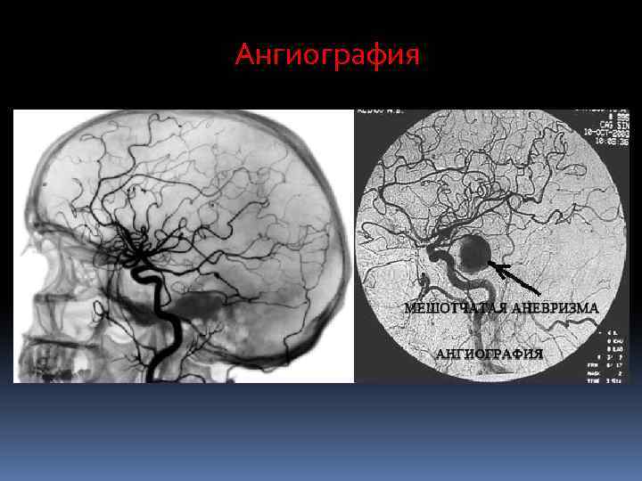 Ангиография 