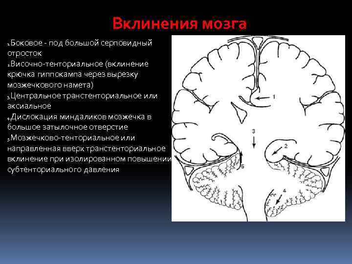 Вклинения мозга Боковое - под большой серповидный отросток 2. Височно-тенториальное (вклинение крючка гиппокампа через