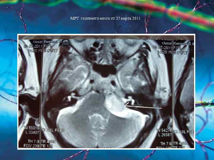 МРТ головного мозга от 27 марта 2011 