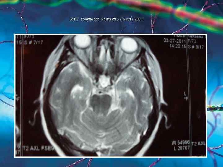 МРТ головного мозга от 27 марта 2011 