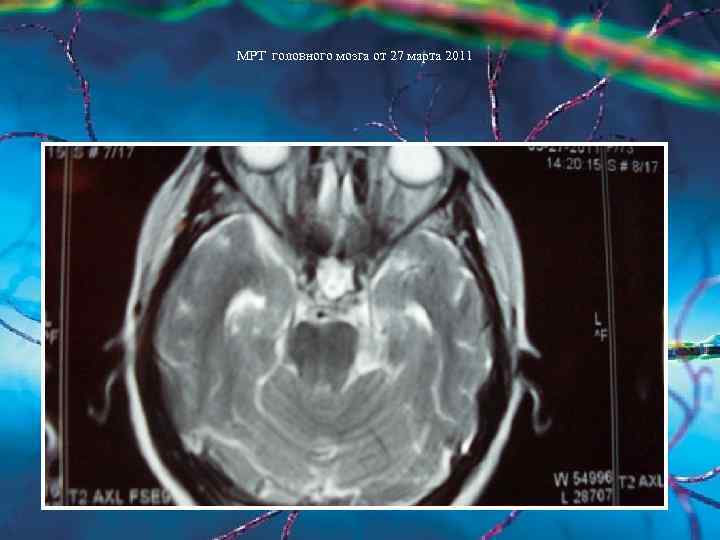 МРТ головного мозга от 27 марта 2011 