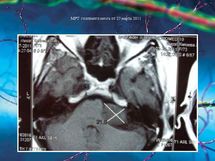 МРТ головного мозга от 27 марта 2011 