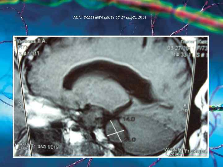 МРТ головного мозга от 27 марта 2011 