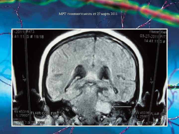 МРТ головного мозга от 27 марта 2011 