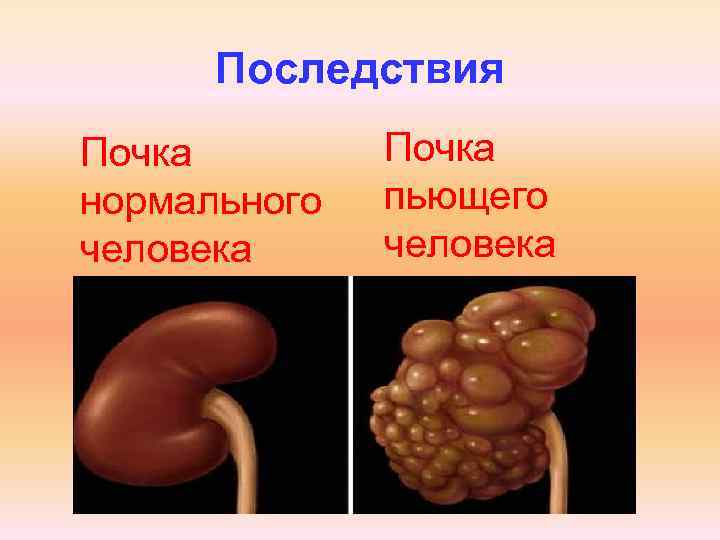 Последствия Почка нормального человека Почка пьющего человека 