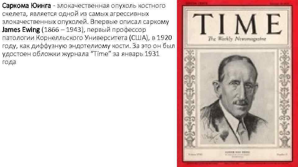 Саркома Юинга - злокачественная опухоль костного скелета, является одной из самых агрессивных злокачественных опухолей.