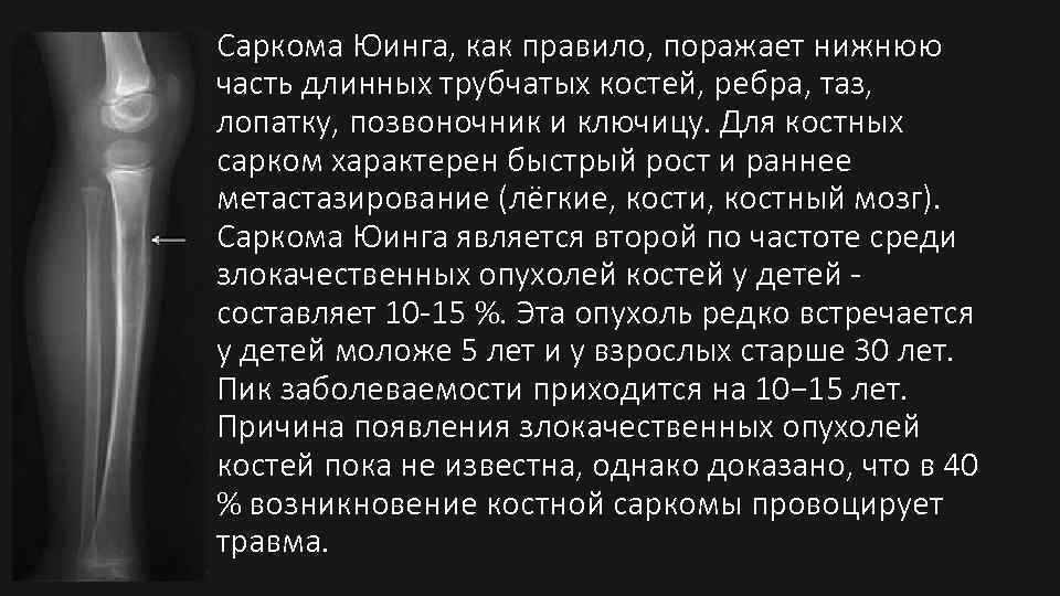 Саркома Юинга, как правило, поражает нижнюю часть длинных трубчатых костей, ребра, таз, лопатку, позвоночник