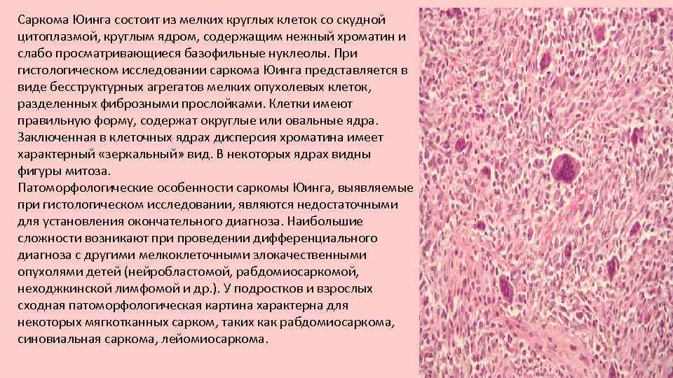 Саркома Юинга состоит из мелких круглых клеток со скудной цитоплазмой, круглым ядром, содержащим нежный