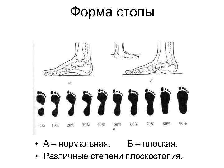 Форма стопы • А – нормальная. Б – плоская. • Различные степени плоскостопия. 