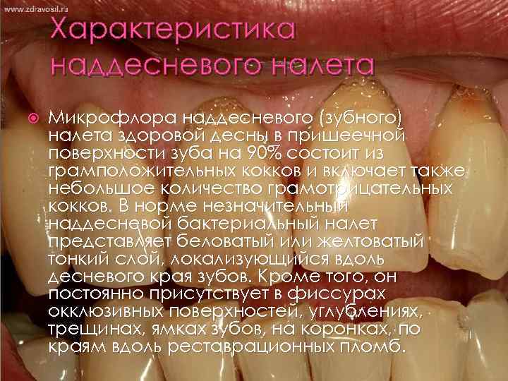 Характеристика наддесневого налета Микрофлора наддесневого (зубного) налета здоровой десны в пришеечной поверхности зуба на