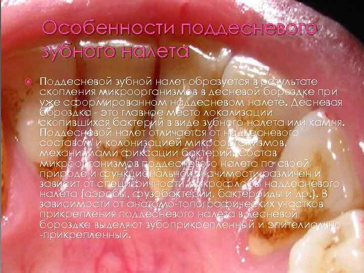 Особенности поддесневого зубного налета Поддесневой зубной налет образуется в результате скопления микроорганизмов в десневой