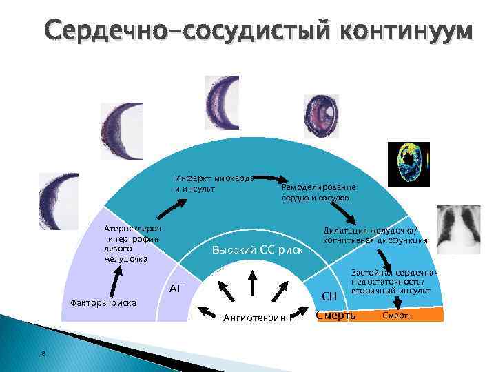 Сердечно-сосудистый континуум Инфаркт миокарда и инсульт Атеросклероз гипертрофия левого желудочка Ремоделирование сердца и сосудов