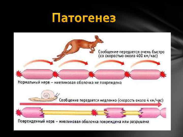 Рассеянный склероз неврология презентация