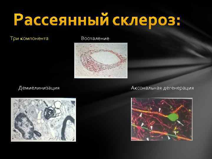 Рассеянный склероз: Три компонента Воспаление Демиелинизация Аксональная дегенерация 