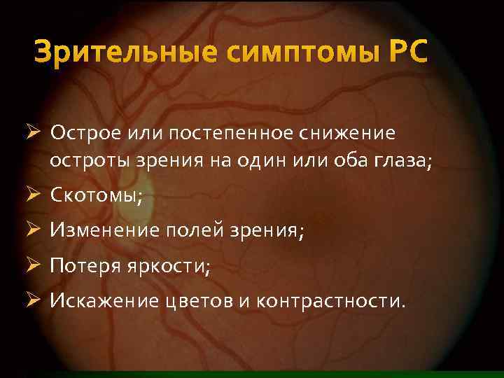 Зрительные симптомы РС Ø Острое или постепенное снижение остроты зрения на один или оба