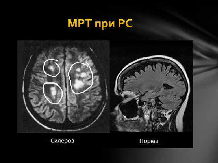 МРТ при РС 