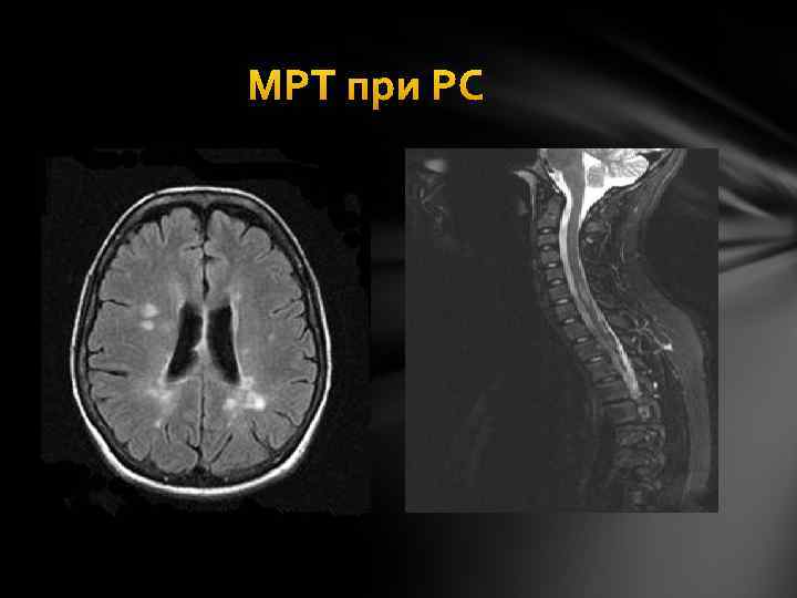 МРТ при РС 