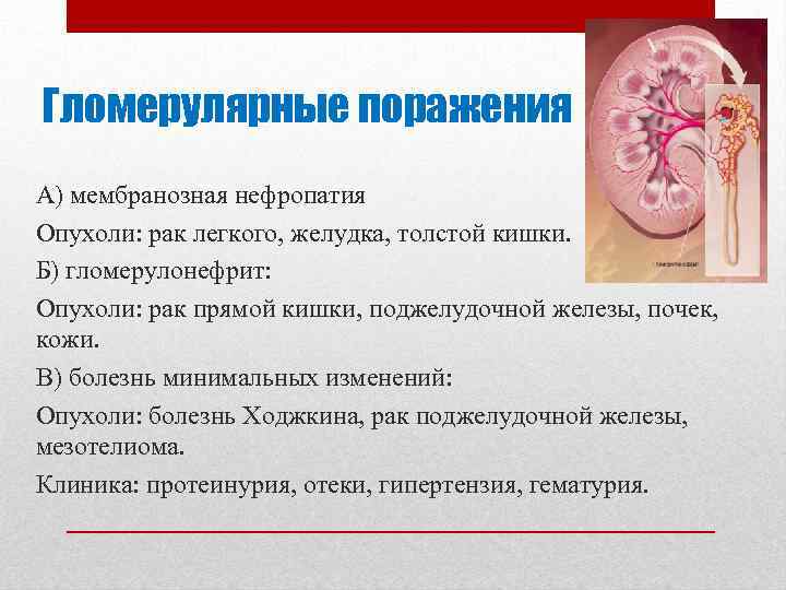 Гломерулярные поражения А) мембранозная нефропатия Опухоли: рак легкого, желудка, толстой кишки. Б) гломерулонефрит: Опухоли: