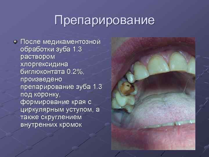 Препарирование После медикаментозной обработки зуба 1. 3 раствором хлоргексидина биглюконтата 0. 2%, произведено препарирование