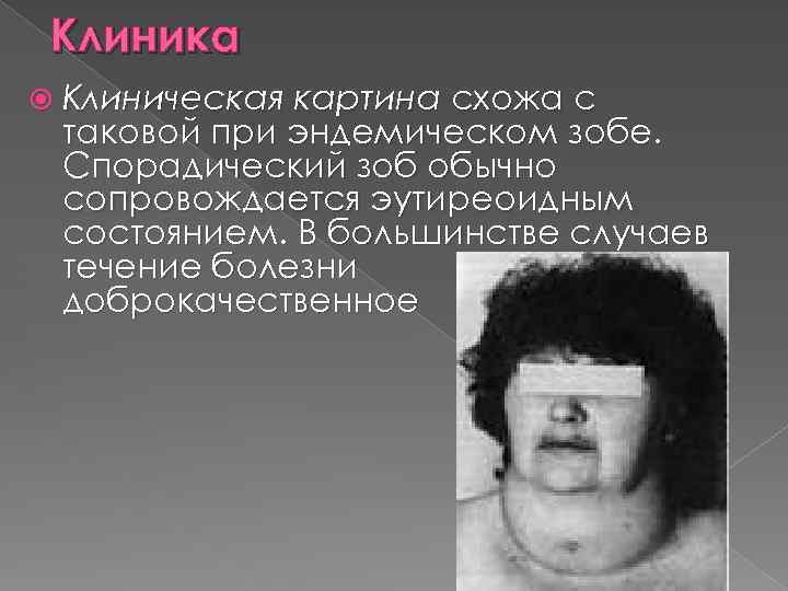 Клиника Клиническая картина схожа с таковой при эндемическом зобе. Спорадический зоб обычно сопровождается эутиреоидным