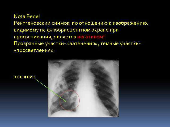 Негативное изображение рентген